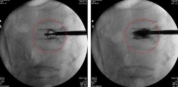 (스파인잭 티타늄 임플란트를 삽입해 척추압박골절 환자의 척추체를 정상에 복원한 모습, 국제바로병원제공)