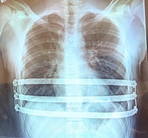 자로주스키 박사가 팩투스(Pectus) 수술을 집도 한 후 촬영한 흉부 X-ray 영상 이미지