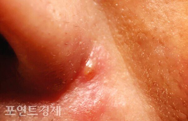 콧망울 옆에 붉게 올라온 수포와 고름이 보이는 피부 병변ⓒ포인트경제 박진우