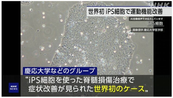 iPS세포를 이용한 척수 손상 치료로 증상 개선이 나타난 세계 최초의 케이스/NHK 보도분 갈무리(포인트경제)