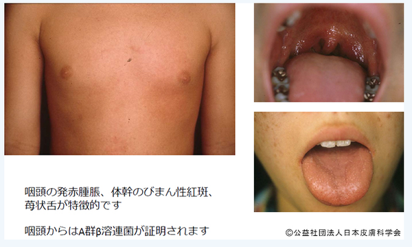 성홍열 환자의 전형적인 증상인 붉은 발진, 인두 발적, 딸기 혀가 확인된다/일본피부과학회 홈페이지 갈무리(포안트경제)