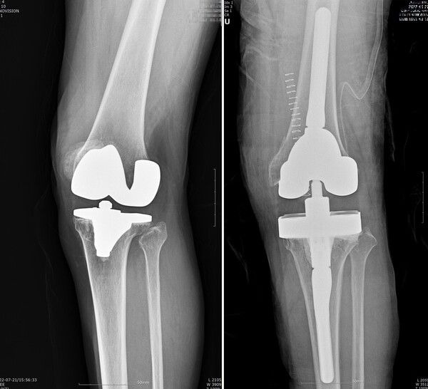인공관절 재치환술 전후 /연세사랑병원 (포인트경제)