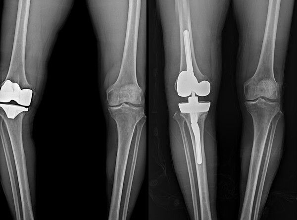무릎 인공관절 재수술 전(좌), 후(우)