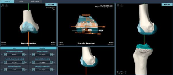 AI를 활용해 무릎 구조를&nbsp;3D로 정밀하게 구현하는&nbsp;OnKnee-U(TKR)