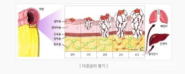 대장암 병기 구분./
