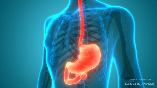 위 내시경을 통한 위암의 조기발견이 중요한데, 적어도 위 관찰시간이 3분은 넘어야 놓치고 지나가는 일이 줄어든다. / 게티이미지뱅크