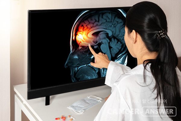 뇌종양 세포만 집중적으로 공격하는 표적항암제 보라시데닙이 암진행 속도를 크게 늦춘다는 연구결과가 뉴잉글랜드 의학저널에 실렸다./캔서앤서 DB