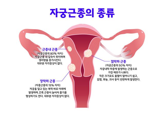 자궁내막종 치료시 카테터를 활용한 에탄올 경화술이 치료효과가 뛰어나다는 연구 결과가 나왔다./게티이미지뱅크