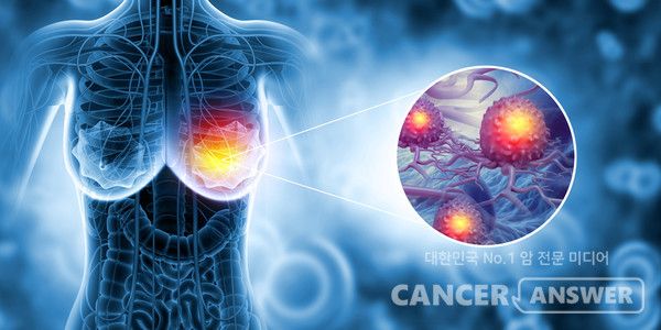 고려대학교 구로병원 종양내과 서재홍 교수팀이 HER2(사람 상피세포 증식인자 수용체2) 양성 유방암 표적치료제 내성을 막는 억제제(HVH-2930)를 발굴, 효과를 입증했다../게티이미지뱅크