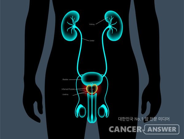 PSA(전립선특이항원) 검사보다 정확도 높고 검사 받기 편한 침 검사로 전립선암을 진단하는 방법이 2024 미국임상종양학회 연례회의에서 발표됐다../게티이미지뱅크