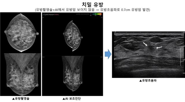 ​치밀유방에서 유방촬영술과 AI로 보이지 않던 유방암이 유방 초음파 상에서는 발견​된다(흰색 화살표)./서울대병원 제공