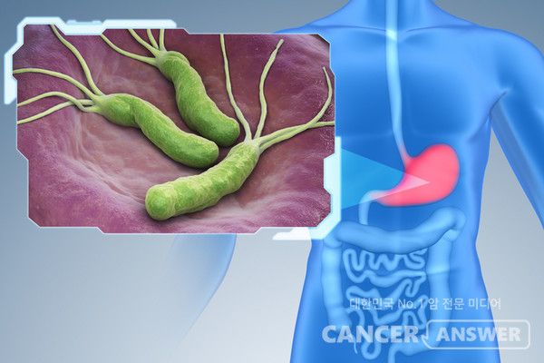 헬리코박터(파일로리)균 감염으로 인한 위궤양이 치매 위험을 3배로 높인다는 연구 결과가 나왔다.&nbsp;가톨릭의대 정신건강의학과 서울성모병원 강동우 교수(제1저자), 여의도성모병원 뇌건강센터 임현국 교수(교신저자) 연구팀은 국민건강보험공단 데이터베이스를 활용해 연구한 결과다. 이 연구 결과는 미국노화학회 공식 학술지인 '제로사이언스(Geroscience)' 최근호에 게재됐다./ 티이미지뱅크