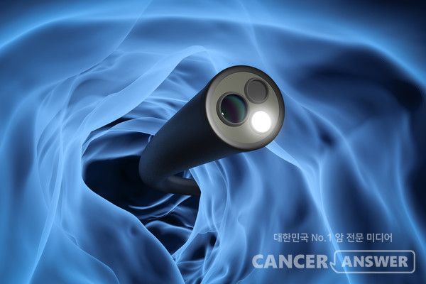 젊을 때부터 대장내시경을 하면서 대장 상태를 점검하고 용종을 제거하면 대장암 발생 및 사망 위험을 크게 낮출 수 있다는 연구결과가 나왔다. / 게티이미지뱅크