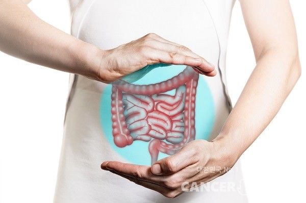 직장암 수술 전 항암방사선 치료 기간은 6주가 일반적이다. 그런데 그 기간을 2주로 줄여도 효과를 볼 수 있다는 국내 연구가 나왔다.&nbsp;수술 전 항암방사선 치료 기간을 3분의 1로 줄였는데 암 치료 성적은 똑같았고, 오히려 환자를 괴롭히는 설사나 복통 같은 부작용은 절반 이하로 뚝 떨어졌다./게티이미지뱅크