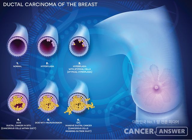 한 번만 투여해도 부작용 없이 유방암 세포를 없애거나 줄이는 유방암 치료 후보물질을 미국 일리노이 어바나-샴페인대 공동연구진이 개발했다고 외신이 보도했다./게티이미지뱅크