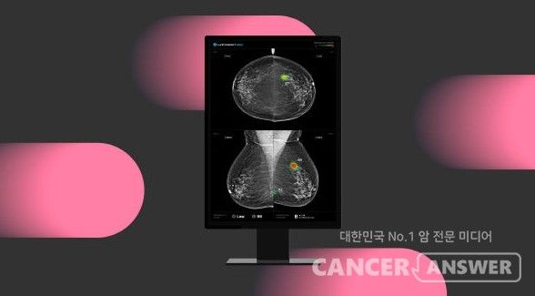 인공지능(AI)을 이용하면 유방암 발견 가능성이 높아진다는 점이 국내 6개 대학병원에서 시행한 대규모 연구에서 확인됐다.&nbsp;의료AI 기업 루닛은 유방촬영술 AI 영상분석 솔루션 ‘루닛 인사이트 MMG’를 활용한 대규모 다기관 전향적 연구 결과가 국제학술지 ‘네이처 커뮤니케이션즈’에 게재됐다고 10일 밝혔다./루닛 제공
