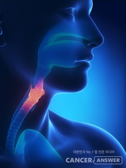 후두암은 두경부암의 대표적인 암이며, 목소리 변화가 가장 큰 증상 중 하나다./게티이미지뱅크