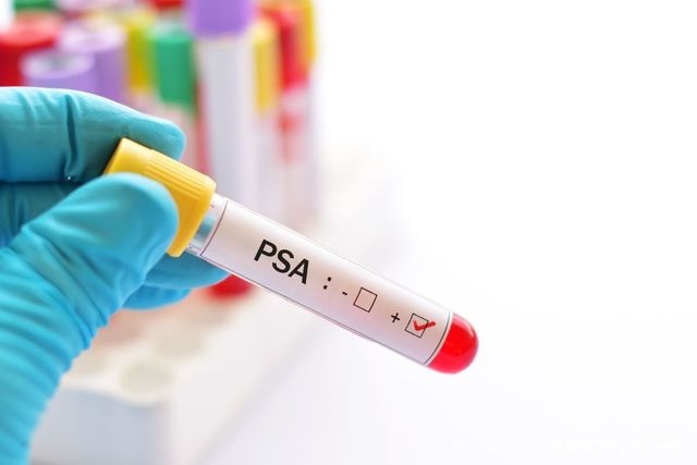 PSA(Prostate-Specific Antigen, 전립선 특이 항원)는 전립선에서 생성되는 단백질로, 혈중 PSA 수치(ng/mL)가 일정 기준을 넘을 경우 암 발생 가능성을 의심하게 된다. PSA 수치가 10 이상은 고위험군, 4 이상 10 미만은 위험군, 4 미만은 정상으로 분류한다. / 게티이미지뱅크