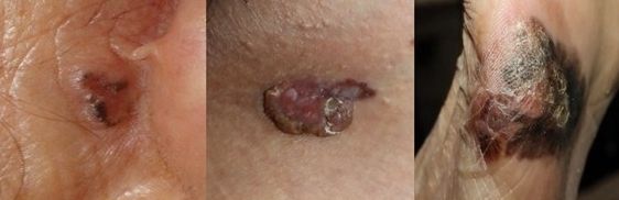 피부암은 종류에 따라 모양이 다르다. 왼쪽부터 기저세포암, 편평세포암, 악성흑색종./서울대병원 제공
