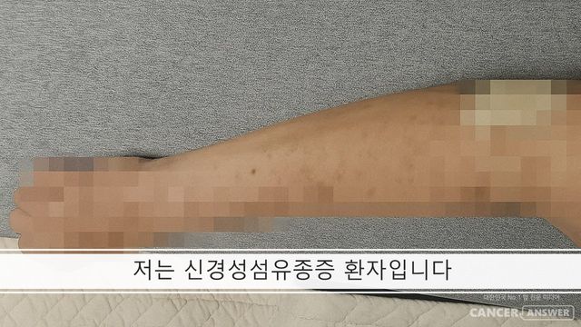 저는 초등학생 때 신경섬유종증 1형 진단을 받았습니다. 치료약이 없어 그저 지켜볼 수 밖에 없었습니다. 코셀루고라는 약이 나왔지만, 19세 이상은 보험급여 대상이 아니라서 연간 3억원이 넘는 약값을 다 부담해야 하니 치료 엄두를 못내고 있습니다./이금희씨 제공&nbsp;