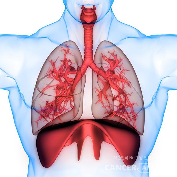 1~2기 단계에서 발견되는 조기 비소세포폐암 환자의 재발 위험을 최대 1년 앞서 예측할 수 있는 인공지능 모델을 국내 의료진이 개발했다.&nbsp;삼성서울병원 폐식도외과 김홍관 교수, 혈액종양내과 정현애 교수 연구팀은 조기 비소세포폐암 수술 환자의 임상·병리·영상 데이터를 종합해 1년 이내 재발 가능성을 예측하는 딥러닝 기반 모델 ‘레이더 케어(RADAR CARE)’를 개발했다./게티이미지뱅크