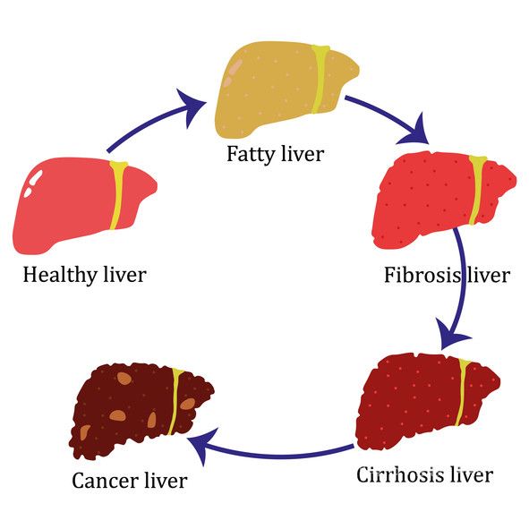 20·30대 지방간 환자의 조기 암 발병 위험이 비질환자보다 20% 높은 것으로 나타났다. 지방간(fatty liver)이 악화하면 간섬유증(fibrosis), 간경변(cirrhosis liver)을 거쳐 간암이 될 가능성이 있다./게티이미지뱅크