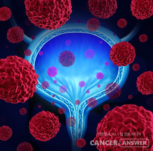 식품의약품안전처는 방광암을 진단하는 데 보조적으로 사용할 수 있는 국산 ‘유전자 검사 시약’을 신개발의료기기로 허가했다고 8일 밝혔다.&nbsp;이 검사 시약은 환자 소변 속의 메틸화된 특정 유전자(PENK)를 분석해서 방광암 여부를 진단한다./게티이미지뱅크