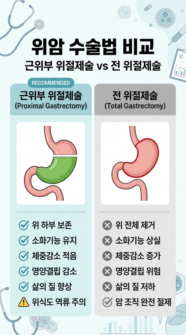 위암 수술의 기본 원칙으로 여겨졌던 ‘위 전절제술’보다 위 전체를 제거하지 않고 암이 발생한 위의 상부만 절제하는 ‘근위부 위절제술(Proximal Gastrectomy)’이 안전성은 유지하면서도 환자의 삶의 질을 개선할 수 있다는 다국적 공동 연구 결과가 발표됐다./AI 그래픽
