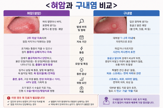 구강암의 일종인 설암은 초기 증상이 구내염과 비슷하다. 증상이 2주 이상 지속되면 암을 의심해야 한다. 구설암과 구내염 비교 그래픽./AI이미지