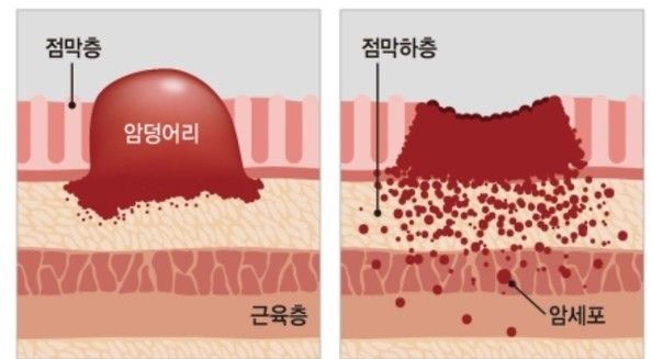 왼쪽이 일반적인 '장형 위암'이고 오른쪽이 젊은층에 많이 생기는 '미만형 위암'이다.