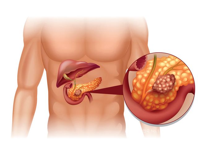 난치암으로 여겨지는 췌장암 치료 효과가 기존 표준치료의 2배에 달하는 경구용 항암제에 대한 글로벌 임상3상 결과가 6월초 열린 ‘2026 미국임상종양학회(ASCO)’ 연례학술대회에서 발표됐다.&nbsp;미국 레볼루션메디신의 경구용 항암제 후보물질 ‘다락손라십(daraxonrasib)’ 임상연구 대상은 이전에 전신 항암치료를 받은 전이성 췌관선암 환자들이다. 췌관선암은 췌장암의 약 90%를 차지하는 가장 흔한 유형으로, 예후가 나쁘고 치료가 어려운 것으로 알려져 있다../게티이미지뱅크