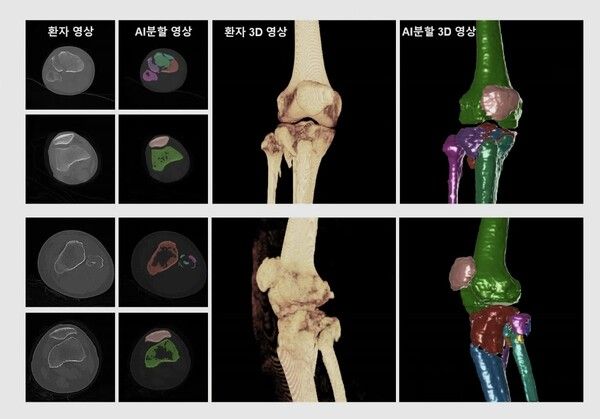 카비랩, 정형외과 수술계획 자동화를 위한 컴퓨터 비전 AI 기술 '사이언티픽 리포트' 게재