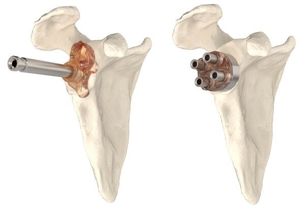 ‘올시스트 숄더’의 어깨 인공관절치환 수술 적용 렌더링 예시 (관절와 체결 위치)