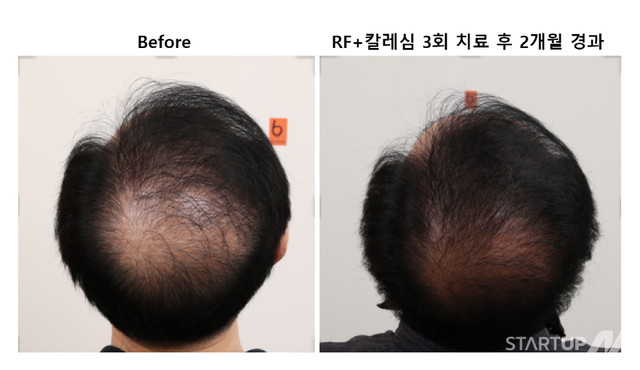 슈퍼엑소좀 PTT-6 기반 탈모·피부재생 솔루션 '칼레심'을 활용한 국내 탈모 임상 사례. (제공= 칼레심)