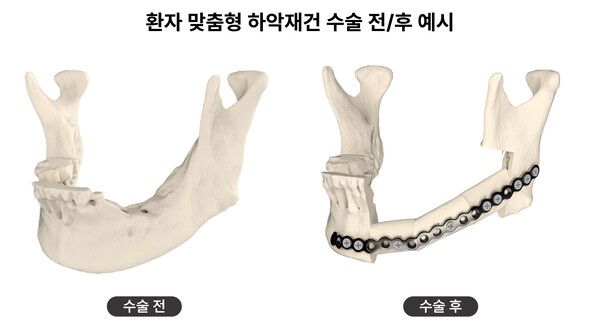 환자 맞춤형 의료기기를 적용한 하악재건술 수술 전/후 3D 그래픽 예시