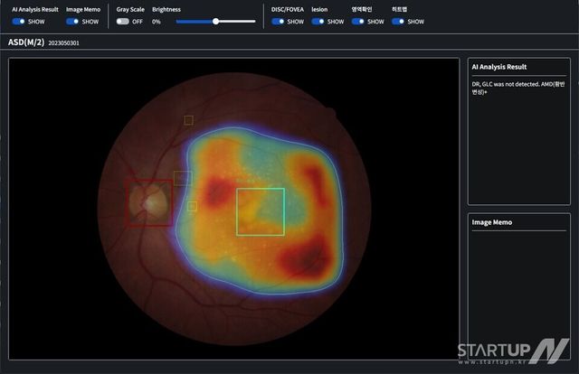 AI로 분석된 안저 영상