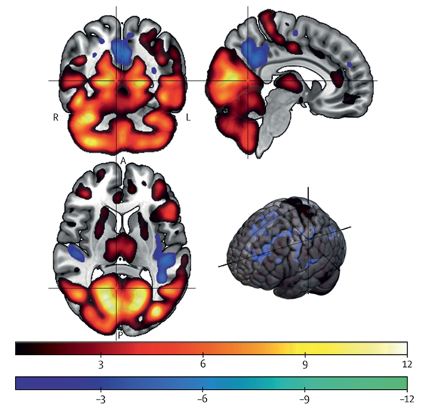 엄마의 혈중 PFAS 농도가 높을수록 아이의 뇌 구조에서 회백질 부피 차이가 나타났다. ⓒ데일리포스트=이미지 제공/The Lancet Planetary Health (2025)