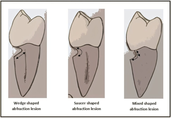 현대 인류 치아에서 관찰되는 '아브프랙션(abfraction)' 병변의 형태.V자형·U자형 등 다양한 형태로 나타나며, 주로 강한 저작력과 식습관의 복합 작용으로 발생한다.&nbsp;ⓒ데일리포스트=이미지 제공/Wikimedia Commons