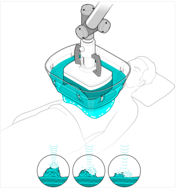 히스토소닉스의 ‘에디슨(Edison)’ 시스템은 물로 채운 막을 통해 집속 초음파를 체내로 전달한다. 종양 내부에서 미세 기포가 생성·붕괴하며 발생한 기계적 충격이 암세포를 파괴해 조직을 액체에 가깝게 만든다.&nbsp;ⓒ데일리포스트=이미지 제공/ⓒGyginfographics.com