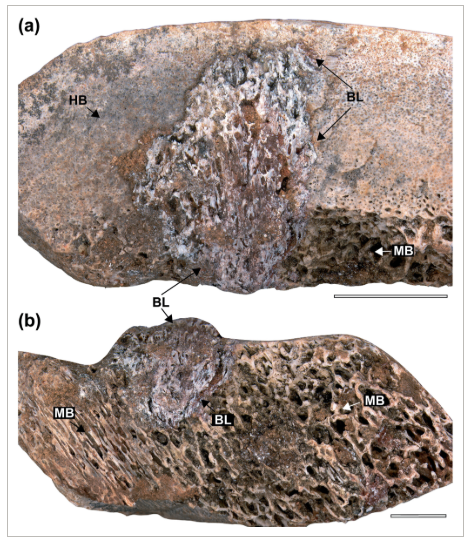 80만 년 전 백악기 후기 공룡 사우로포드 화석 뼈에 골수염(osteomyelitis)으로 인한 병변이 확인된다. ⓒ데일리포스트=이미지 제공/The Anatomical Record