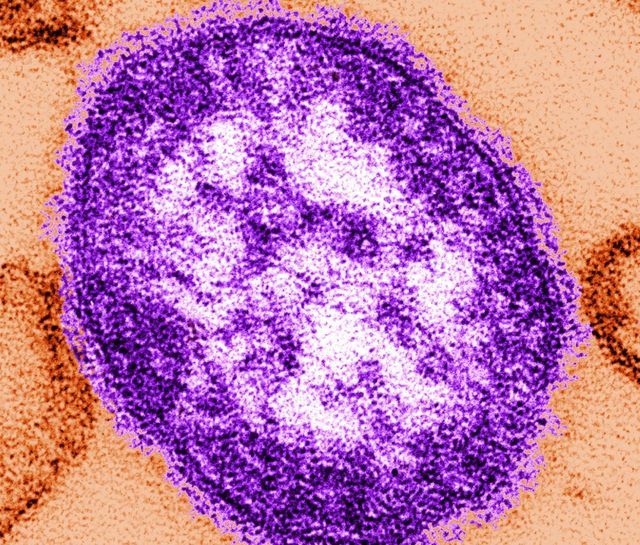 현미경으로 본 홍역 바이러스