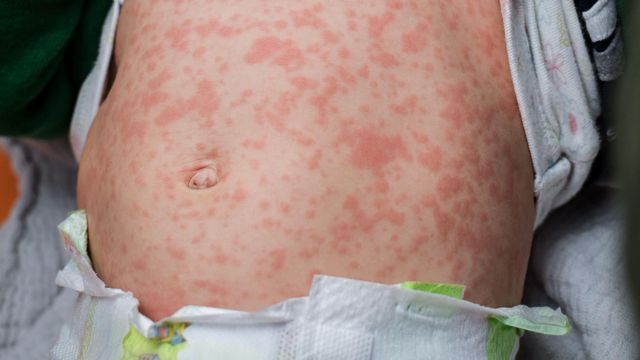 어린아이 배에 난 홍역 발진