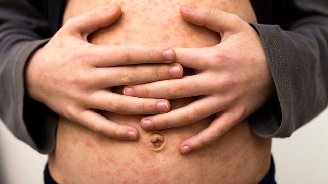 어린아이 배에 난 홍역 발진