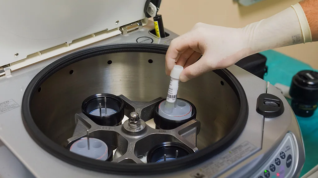 정자 냉동을 진행하는 모습