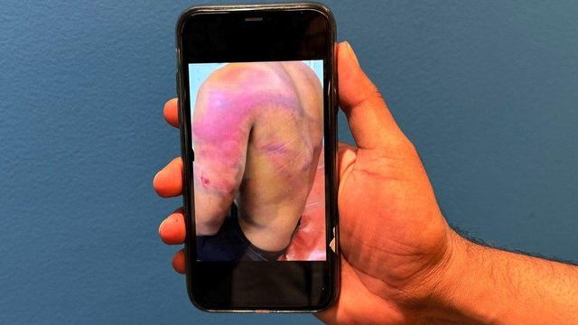 멍이 든 남성의 등을 찍은 사진