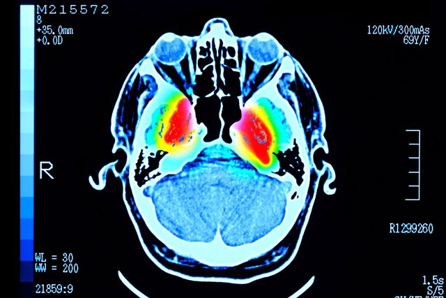 인간의 뇌를 스캔한 이미지. 중심에 붉은색, 노란색 등으로 표시되어 있다