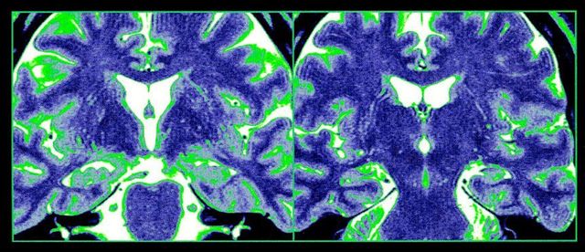 대칭적인 패턴을 보여주는 정상 해마의 MRI 사진