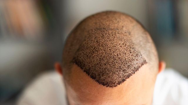 모발이식을 받은 직후의 남성