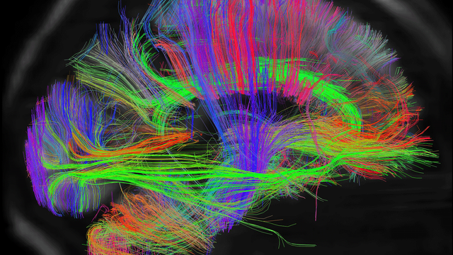두뇌 스캔 사진