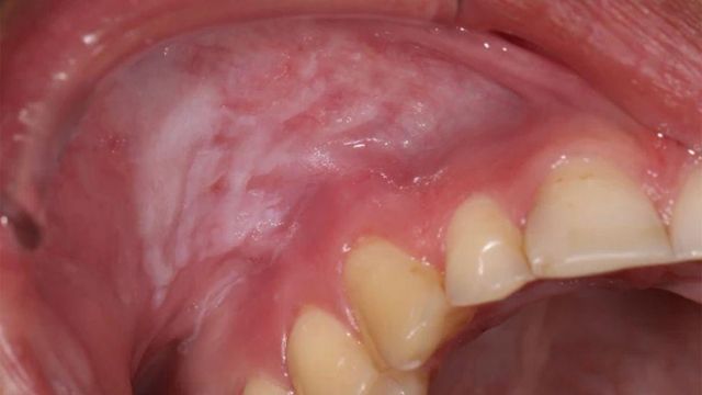 니코틴 파우치로 인해 손상된 잇몸